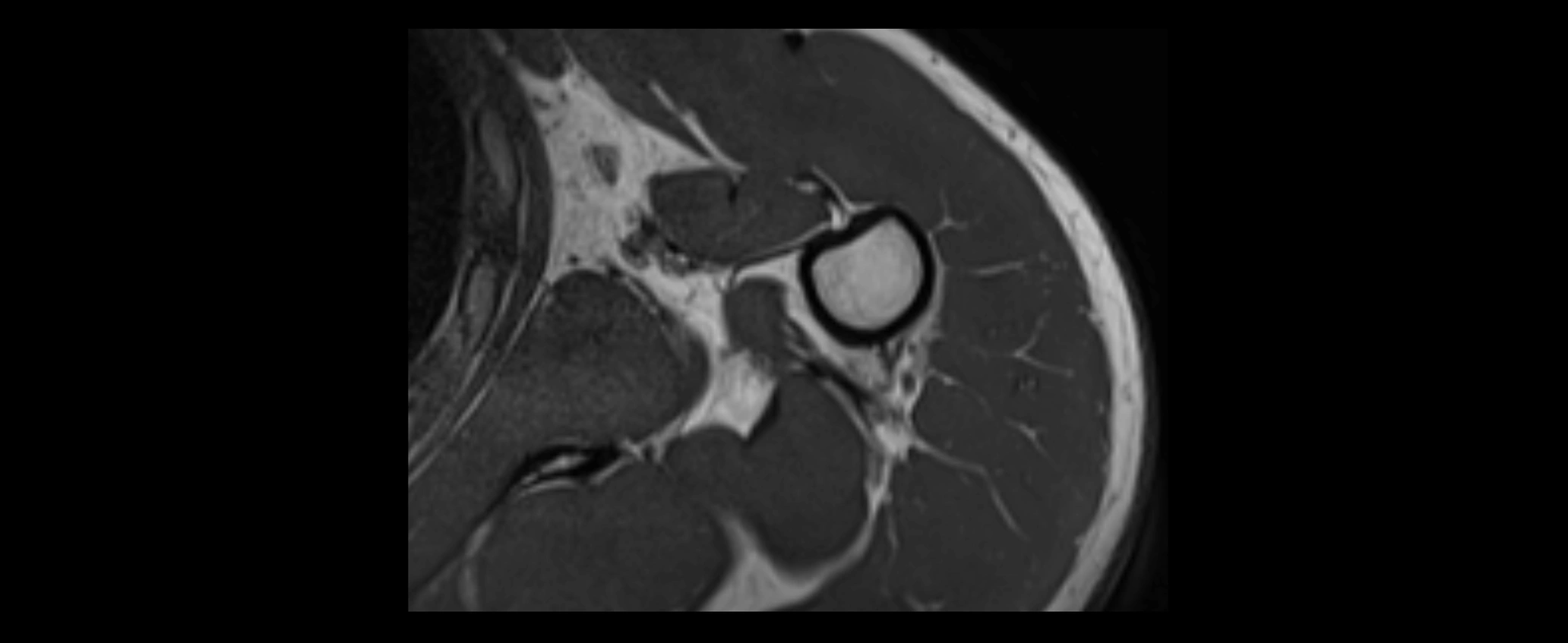 shoulder ligaments axial 3d 3t mri image-img-00005-00103.webp